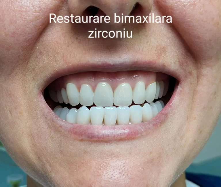 Dr. Sebastian Borodi 2 dr sebastian borodi restaurare bimaxilara zirconiu 768x649