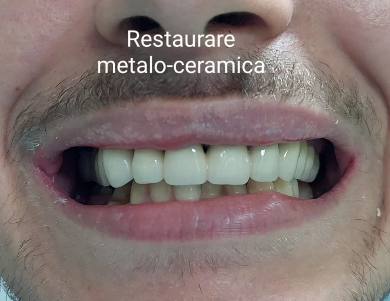 Dr. Sebastian Borodi 7 dr sebastian borodi restaurare metalo ceramica 768x593